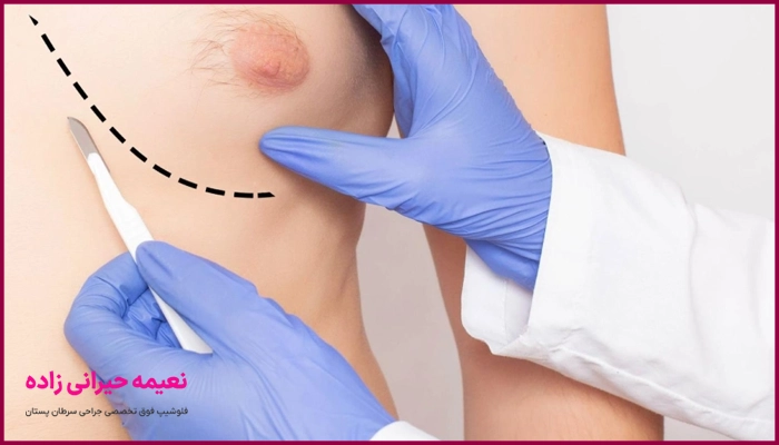 بهترین جراح ژنیکوماستی در یزد
