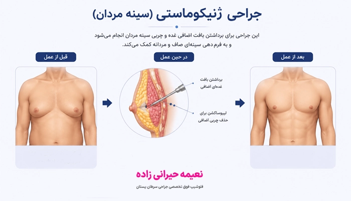 جراحی ژنیکوماستی چیست؟